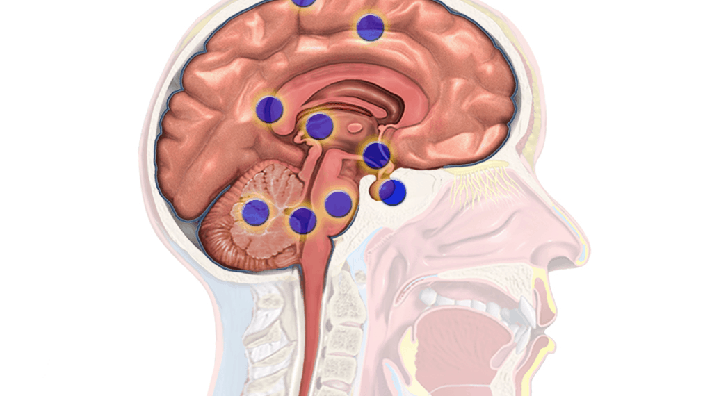 HOW MUCH DO YOU NEED TO INVEST FOR BRAIN TUMOUR SURGERY IN INDIA?