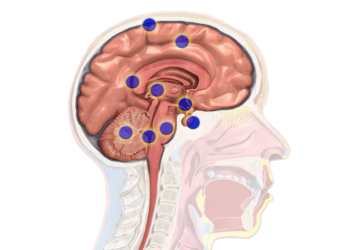 HOW MUCH DO YOU NEED TO INVEST FOR BRAIN TUMOUR SURGERY IN INDIA?