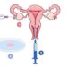 Purpose, Process and Cost of In-vitro Fertilisation Treatment