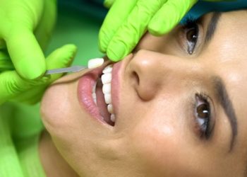 9 Ways to Give Your Veneers Functional Care