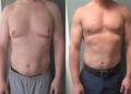 Is it Worth Getting Gynecomastia Surgery?
