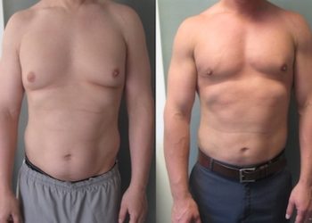 Is it Worth Getting Gynecomastia Surgery?