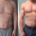 Is it Worth Getting Gynecomastia Surgery?